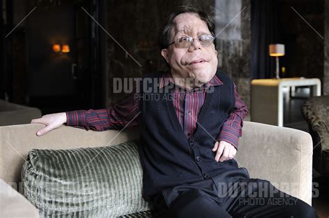 adam pearson als kind